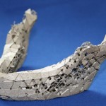 83 year-old woman got 3D printed mandible